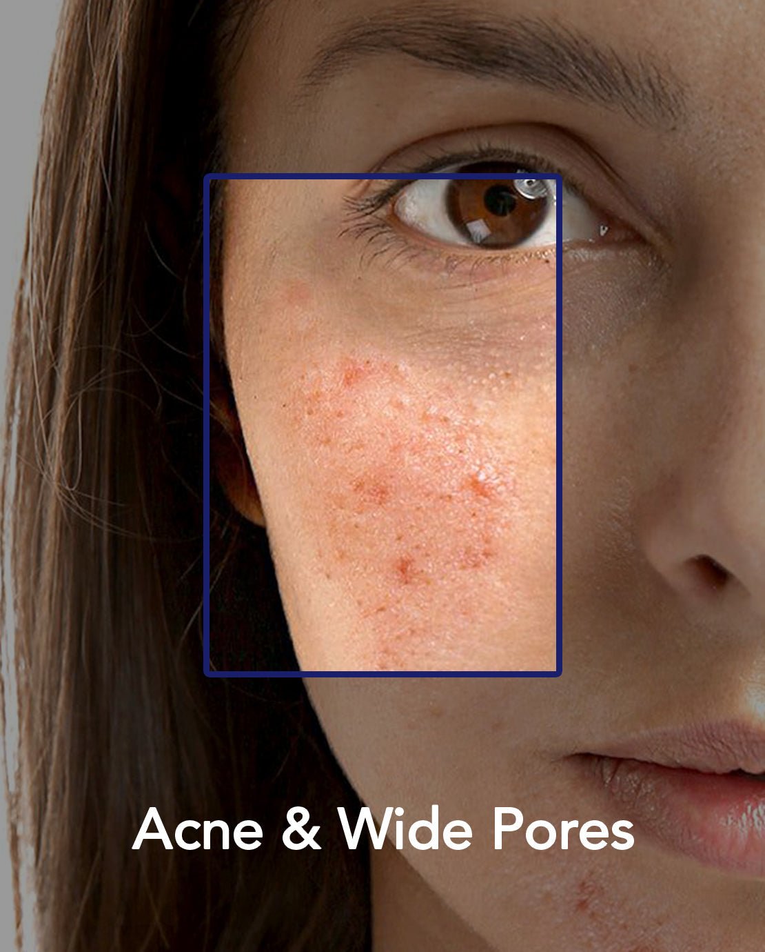 Acne & wide pores